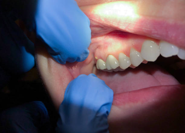 Best Emergency Dental Care for Abscessed Tooth in Elm Creek, TX